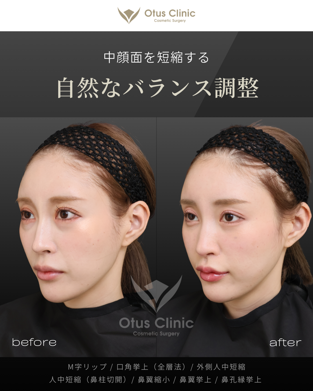 M字リップ ・鼻孔縁挙上 ・人中フル（人中短縮 / 鼻翼縮小 / 鼻翼挙上 / 外側人中短縮 / 口角挙上）