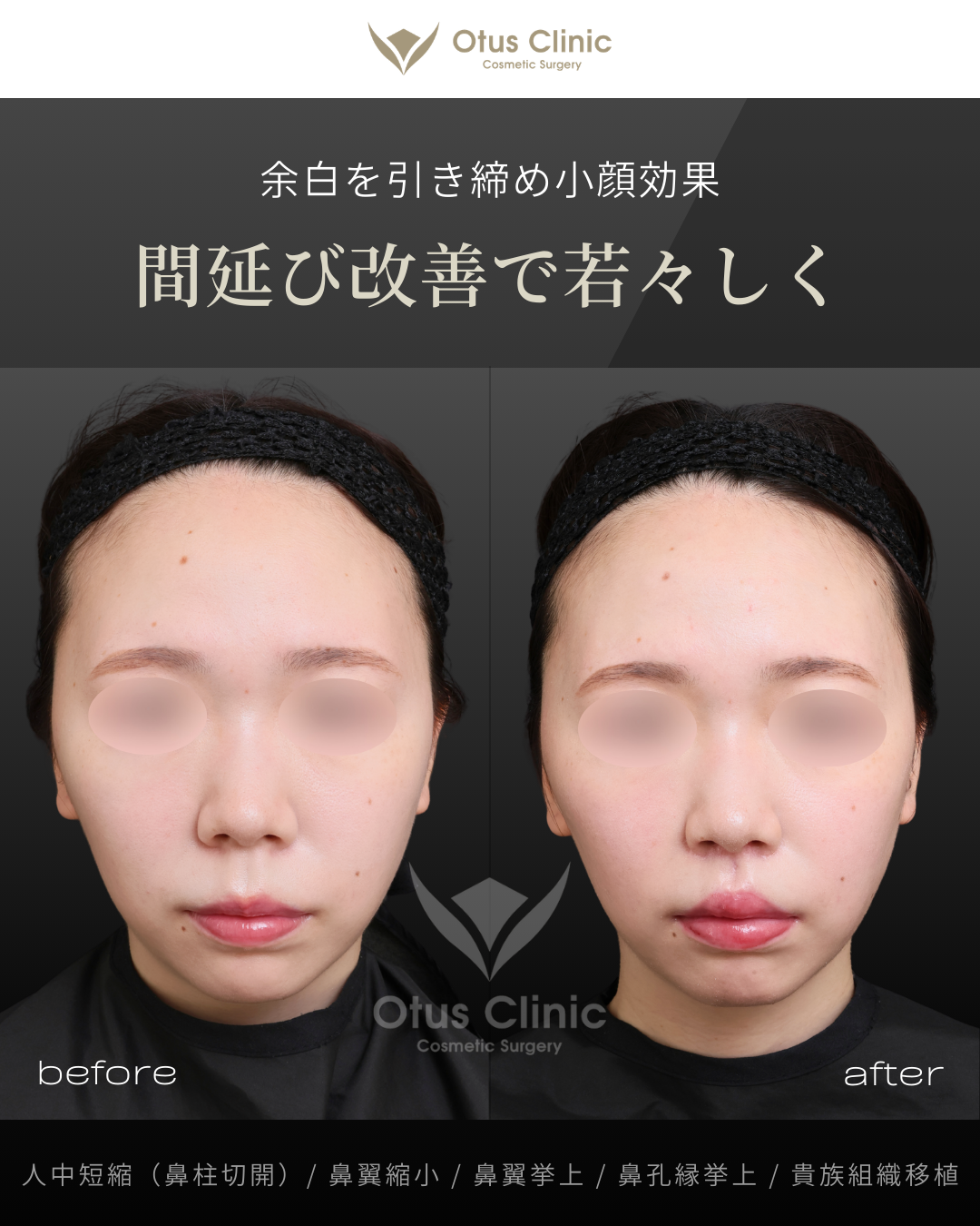 鼻柱切開人中短縮・鼻翼縮小・鼻翼挙上・鼻孔縁挙上・貴族組織移植