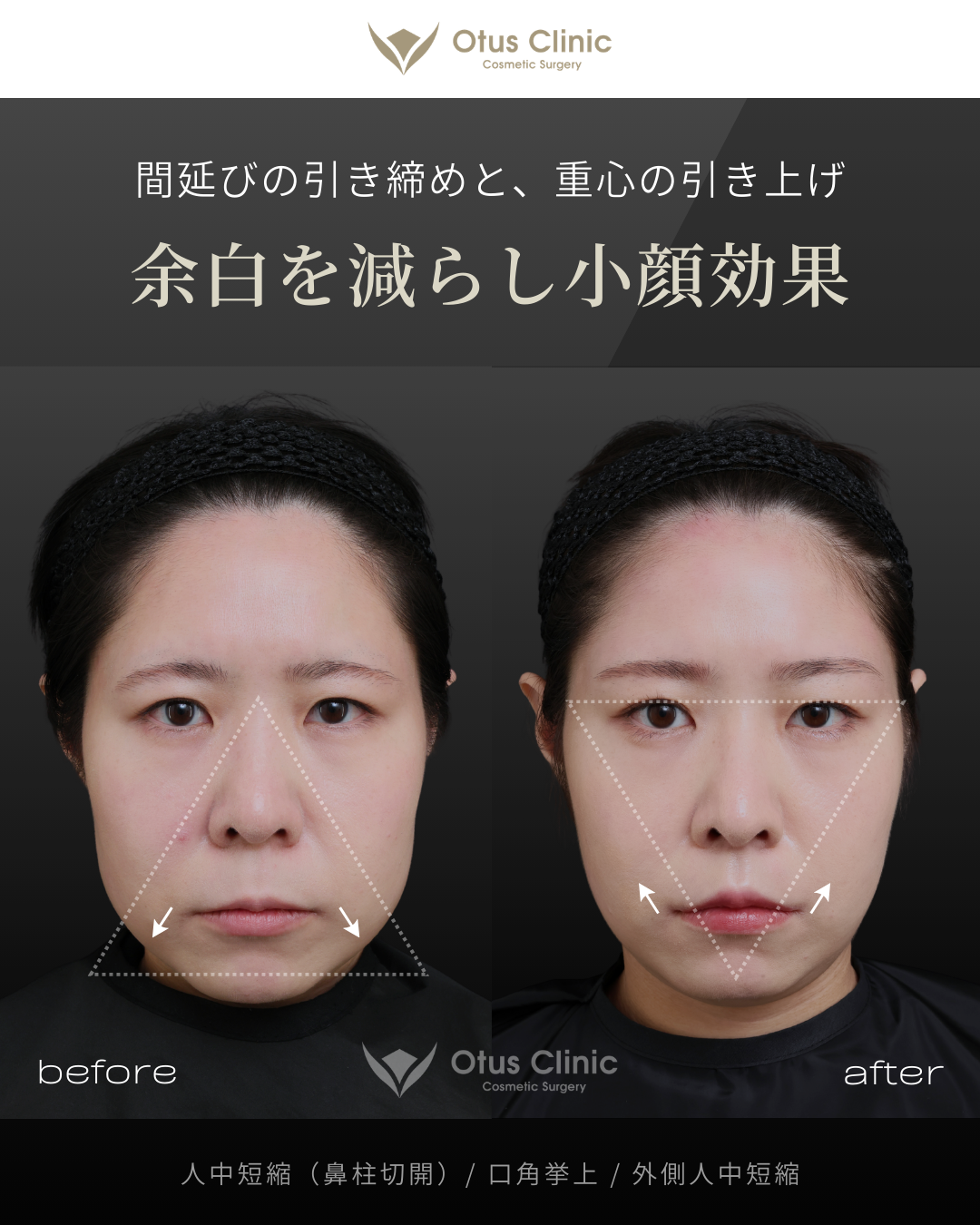 鼻柱切開人中短縮・口角挙上・外側人中短縮