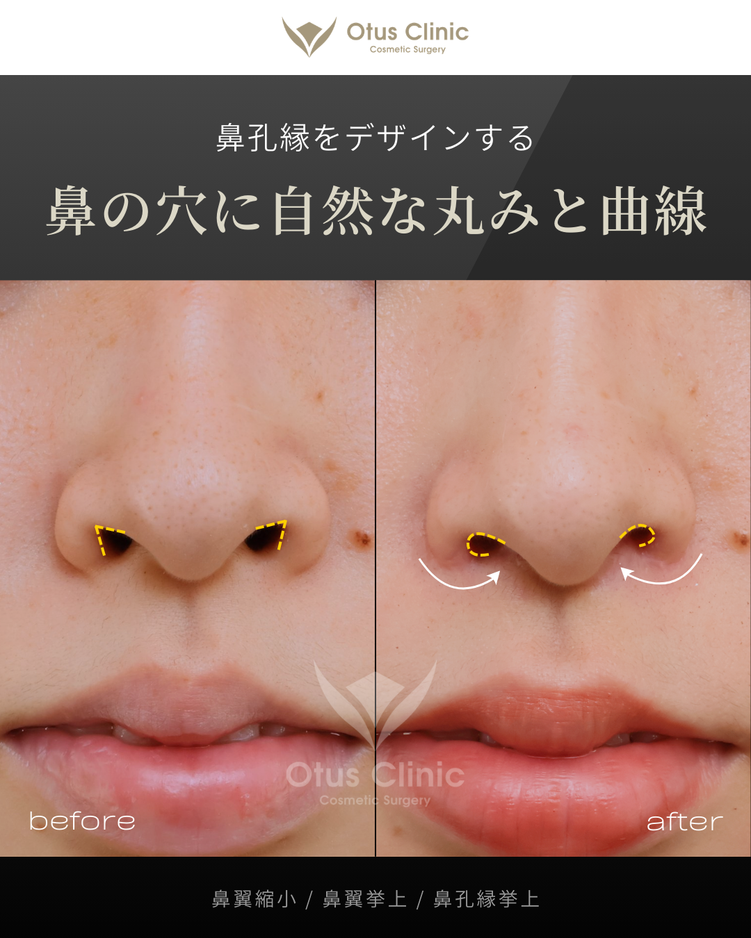 鼻翼縮小・鼻翼挙上・鼻孔縁挙上