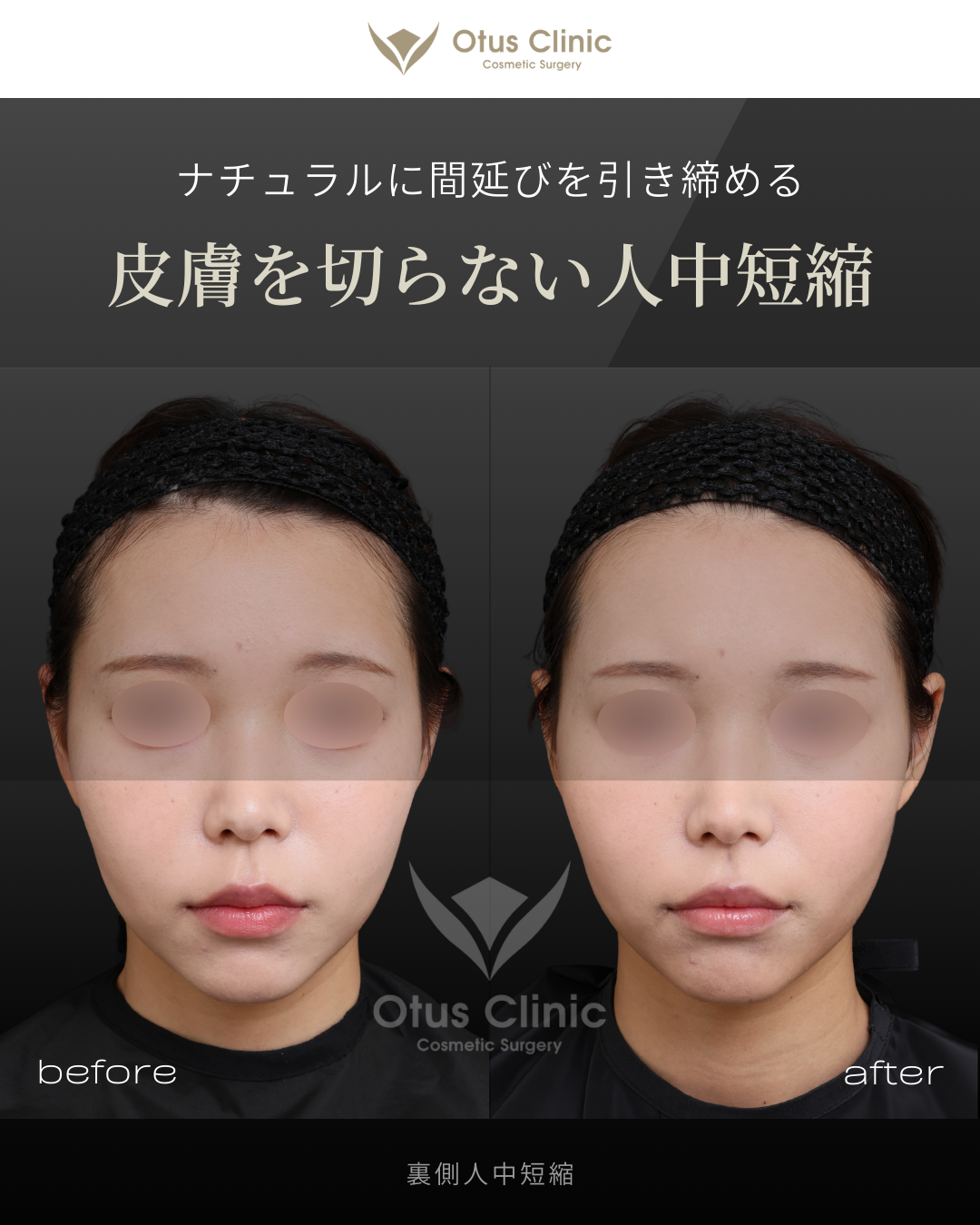 裏側人中短縮（切らない人中短縮）