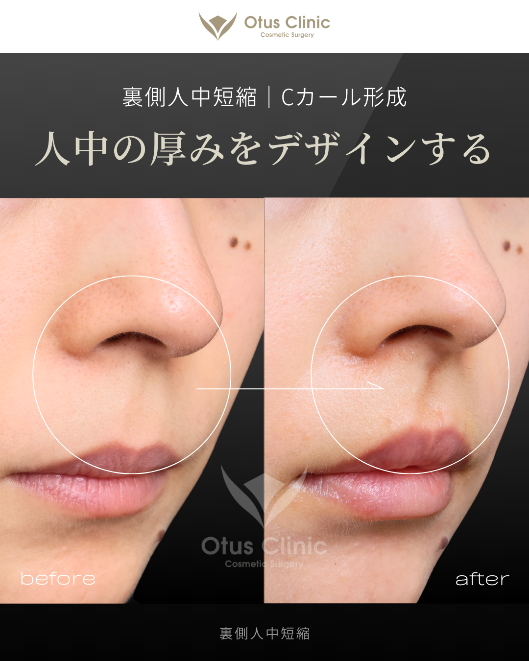 裏側人中短縮（切らない人中短縮）