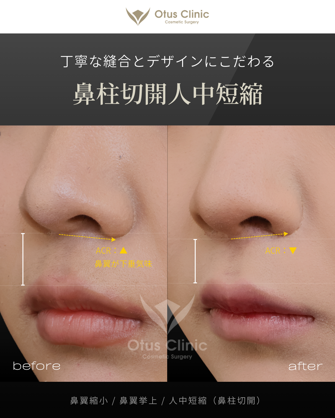 鼻翼縮小・鼻翼挙上・鼻柱切開人中短縮