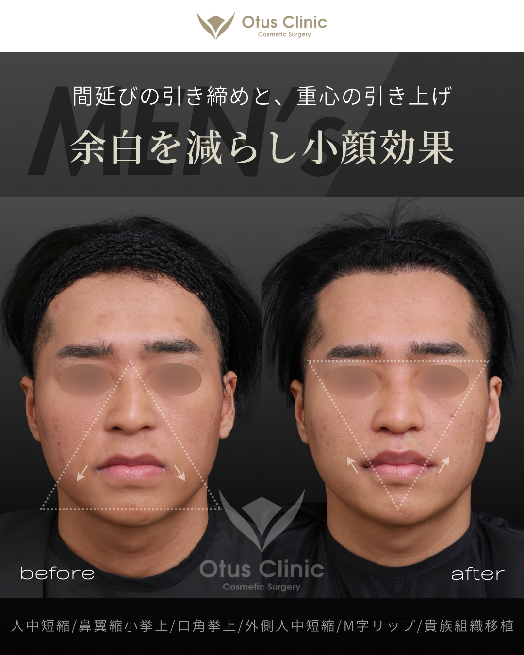 人中フル（人中短縮 / 鼻翼縮小 / 鼻翼挙上 / 外側人中短縮 / 口角挙上）・M字リップ ・貴族組織移植