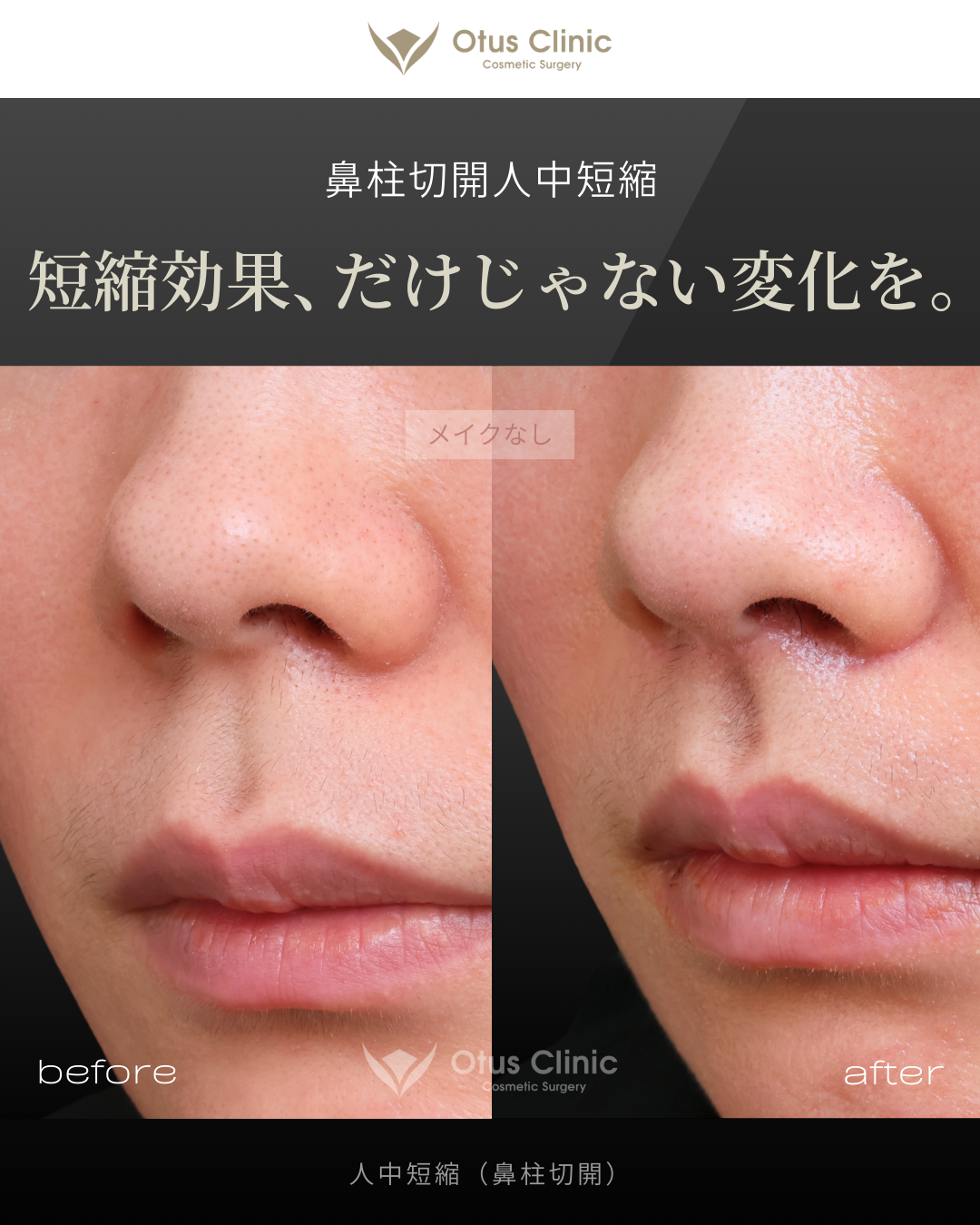 鼻柱切開人中短縮