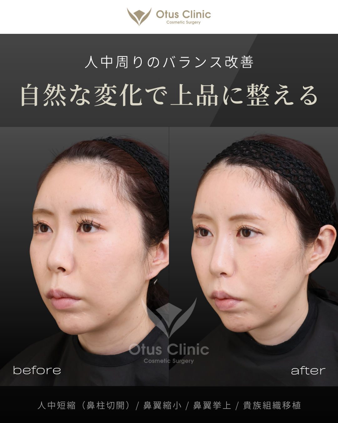 鼻柱切開人中短縮・鼻翼縮小・鼻翼挙上・貴族組織移植