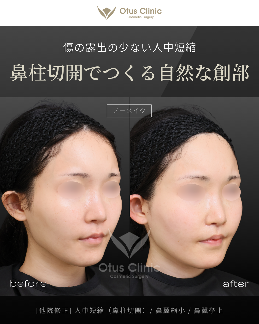 【他院修正】鼻柱切開人中短縮・鼻翼縮小・鼻翼挙上