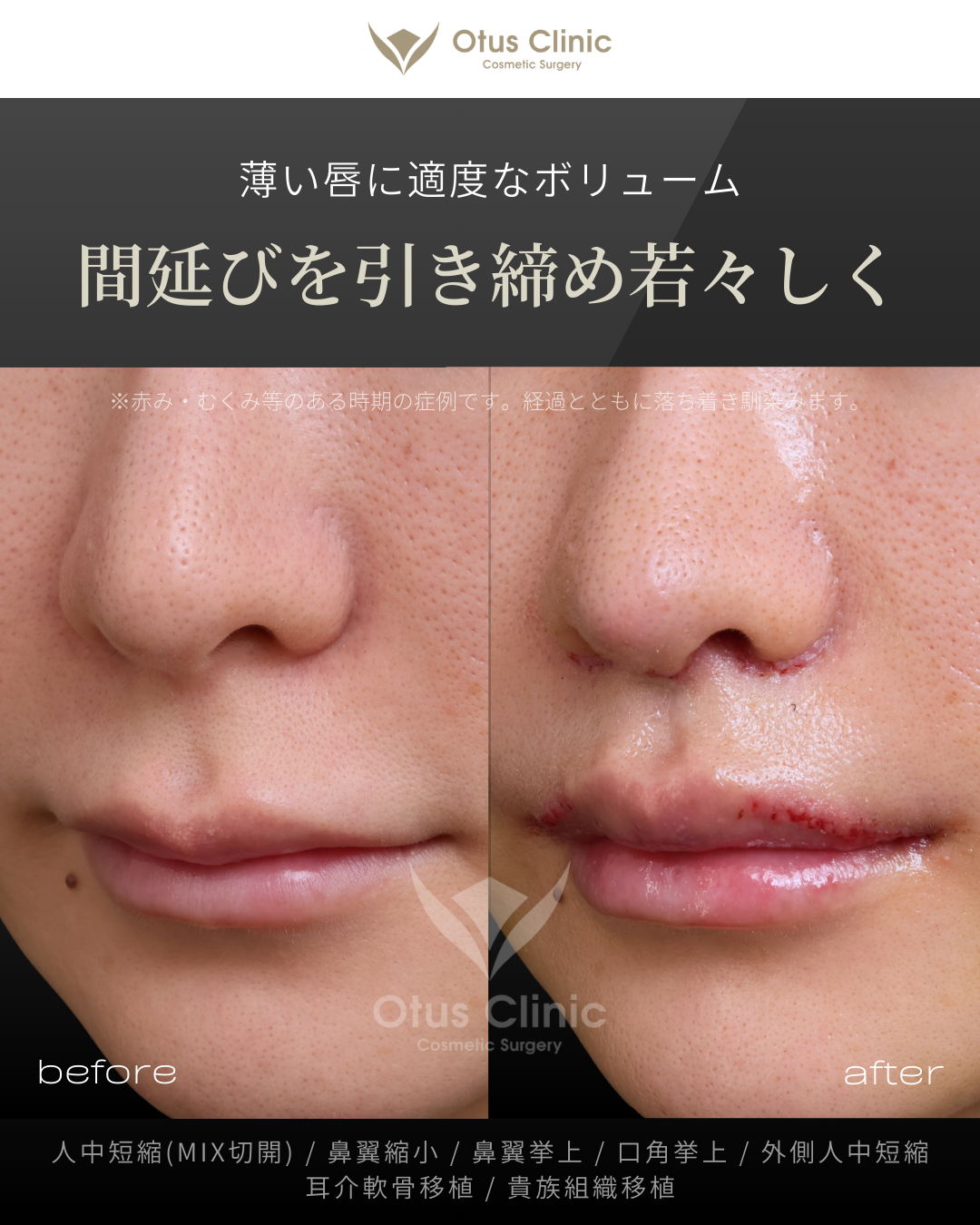 人中短縮(鼻柱切開×鼻孔内切開)・鼻翼縮小・鼻翼挙上・口角挙上・外側人中短縮・貴族組織移植・耳介軟骨移植
