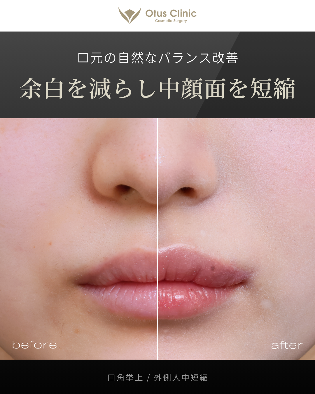 口角挙上・外側人中短縮