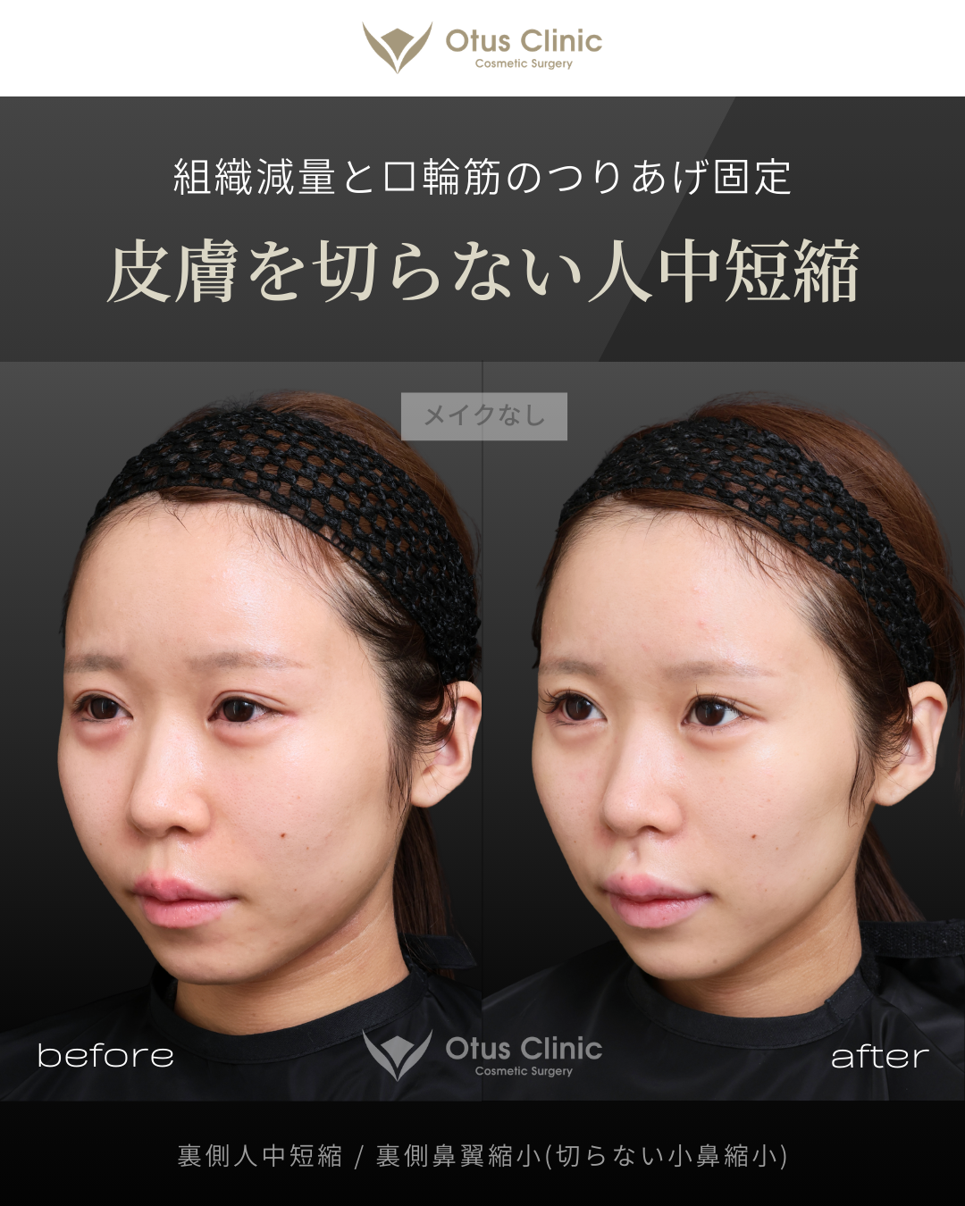裏側人中短縮（切らない人中短縮）・裏側鼻翼縮小（切らない小鼻縮小）