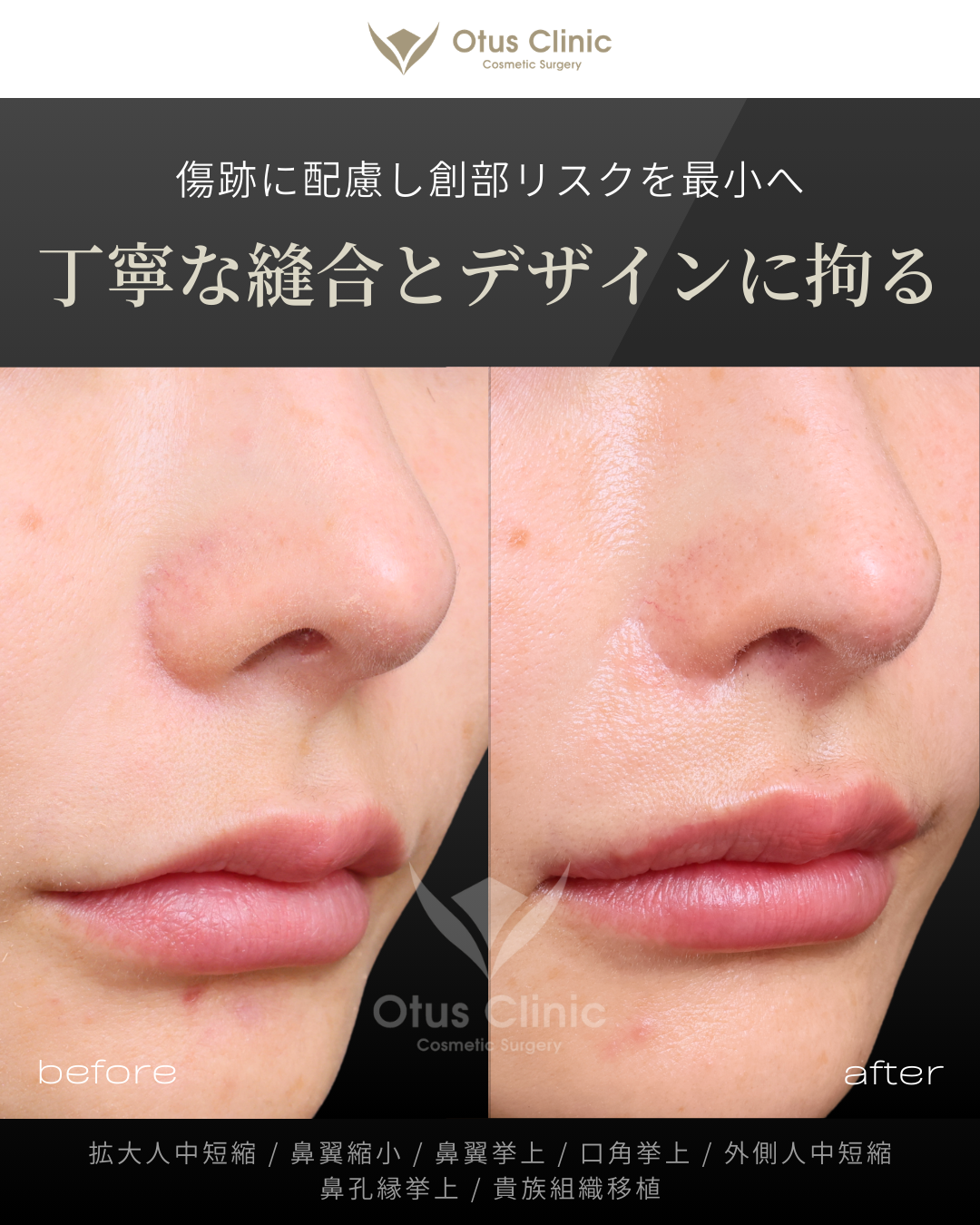 人中フル（人中短縮＋鼻翼縮小＋鼻翼挙上＋口角挙上＋外側人中短縮）・拡大人中短縮・貴族組織移植・鼻孔縁挙上