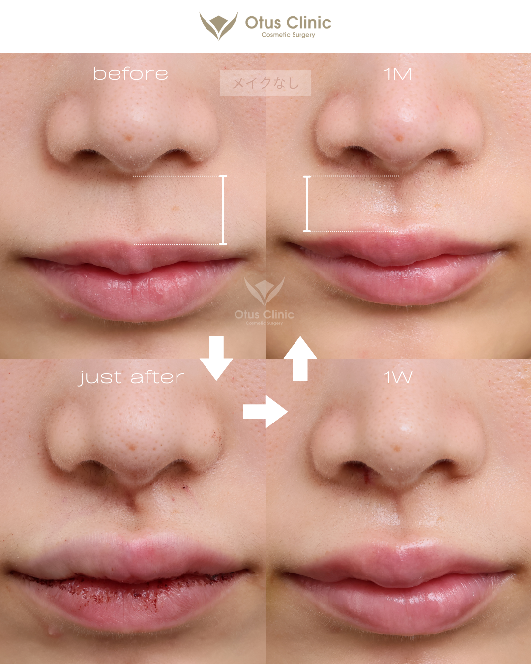 裏側人中短縮（切らない人中短縮）