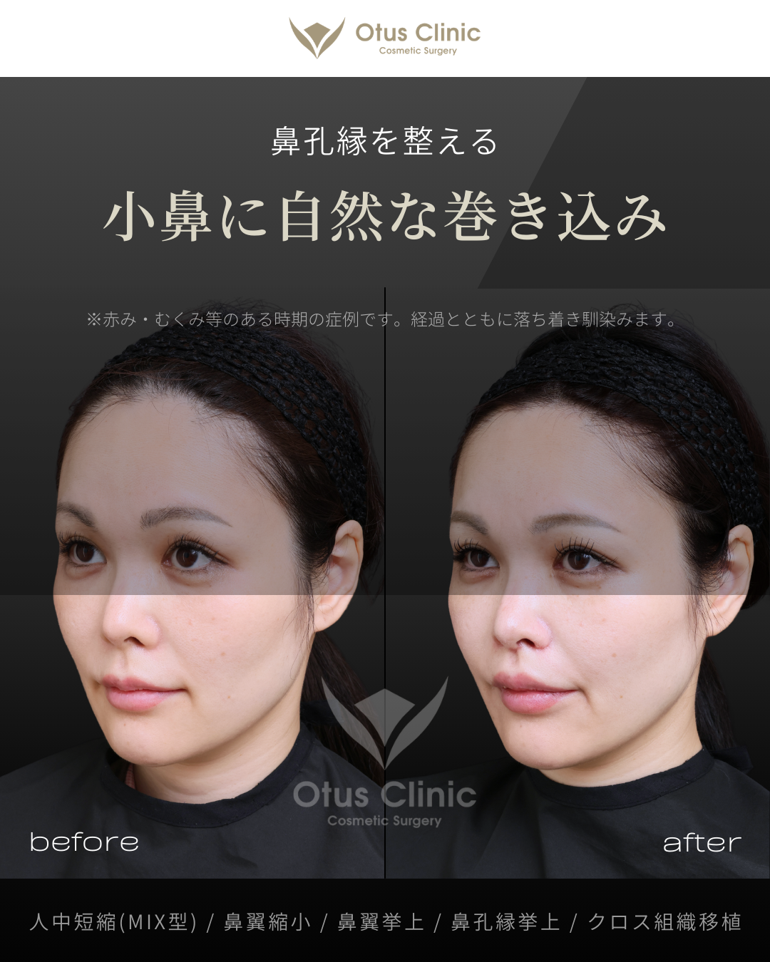 人中短縮(鼻柱切開×鼻腔内切開)・鼻翼縮小・鼻翼挙上・鼻孔縁挙上・クロス組織移植