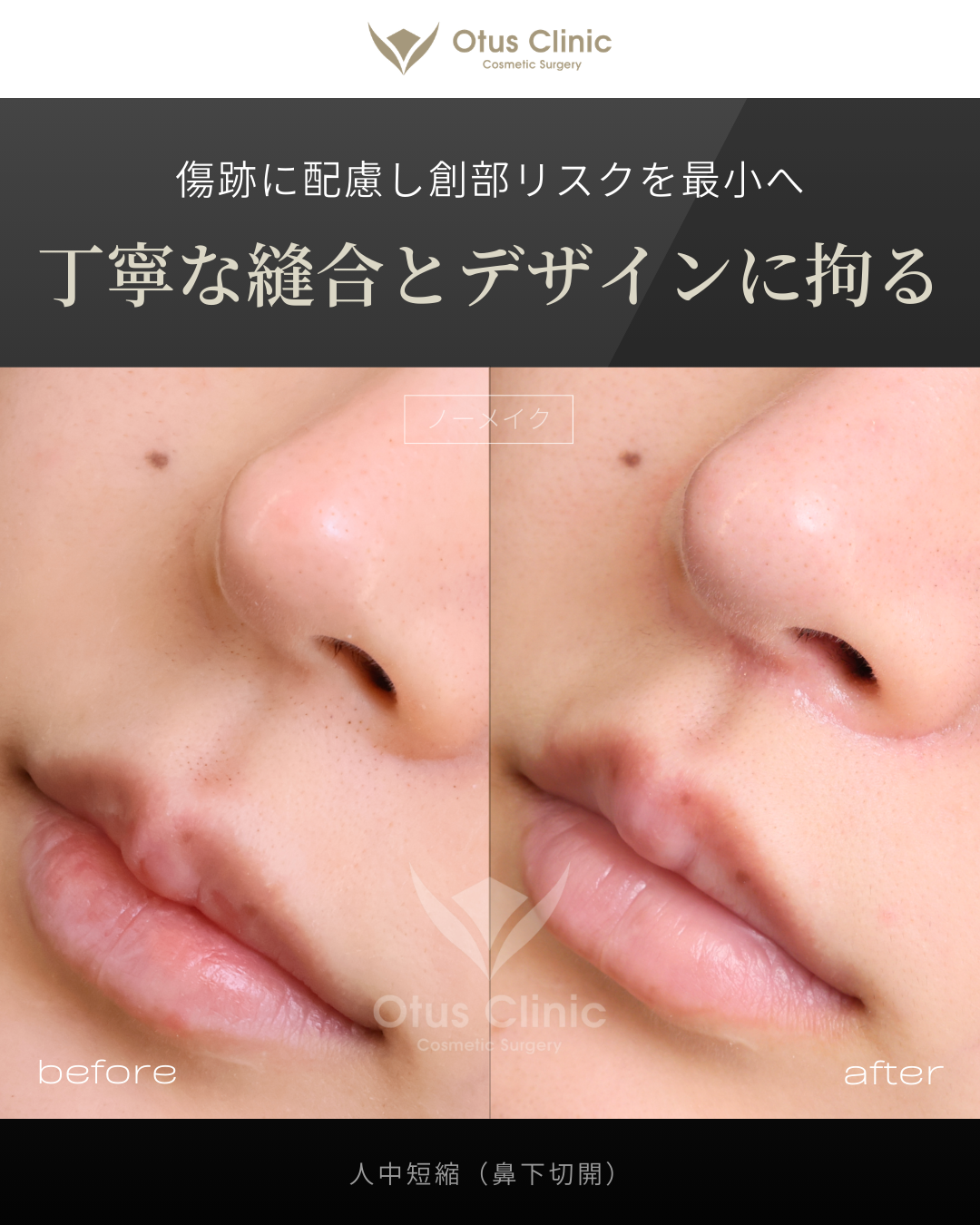 人中短縮(鼻下切開)