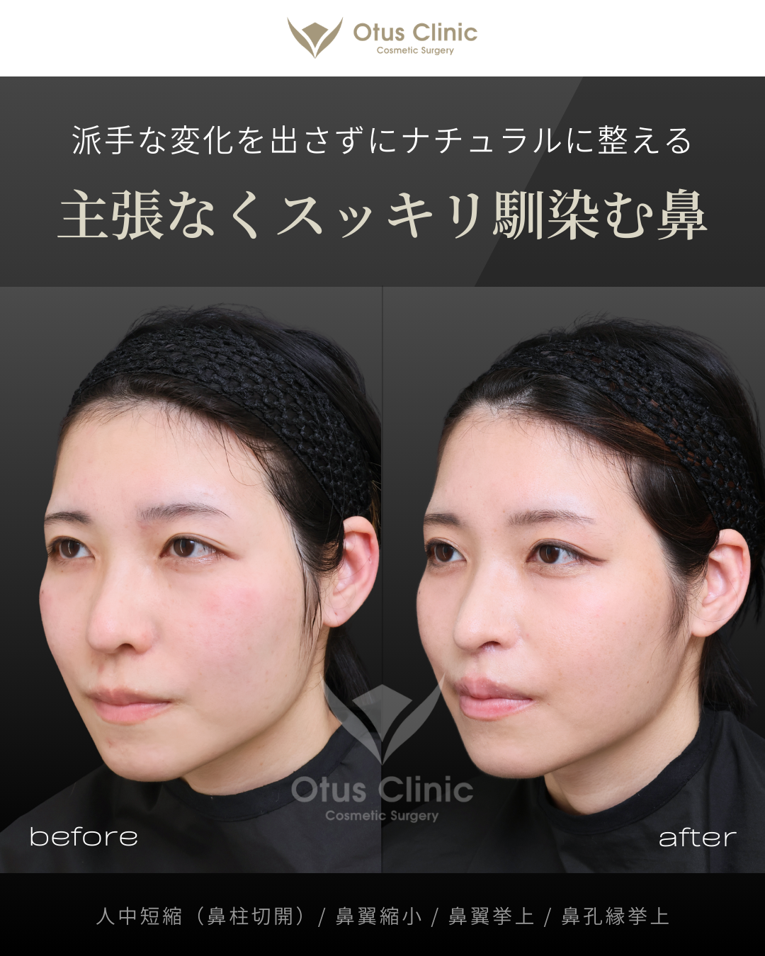 鼻柱切開人中短縮・鼻翼縮小・鼻翼挙上・鼻孔縁挙上