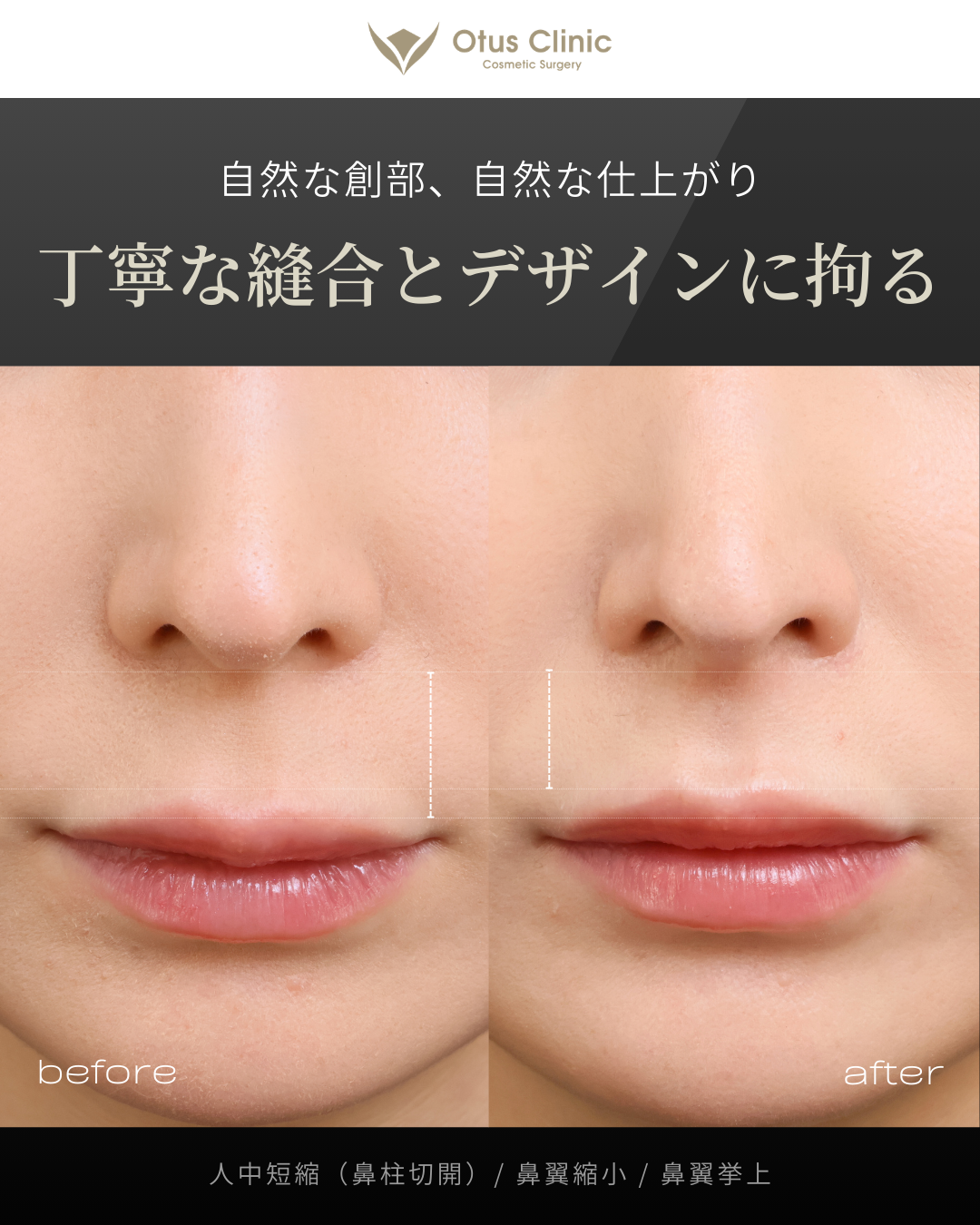 鼻柱切開人中短縮・鼻翼縮小・鼻翼挙上