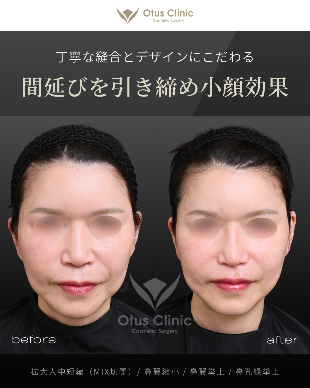 拡大人中短縮（MIX切開）/ 鼻翼縮小 / 鼻翼挙上 / 鼻孔縁挙上