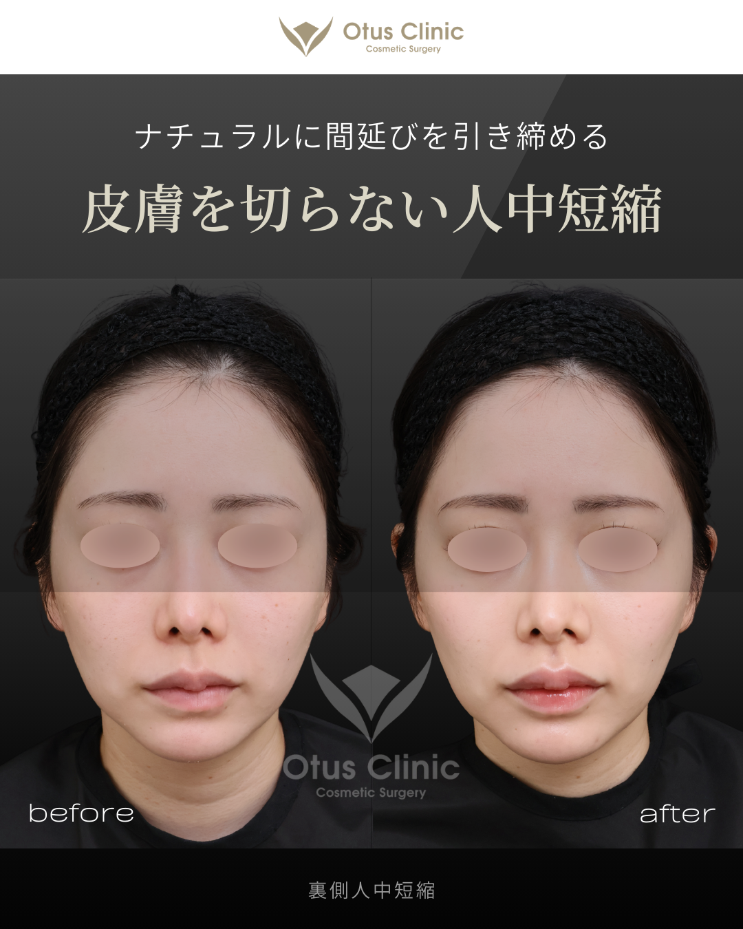 裏側人中短縮（切らない人中短縮）