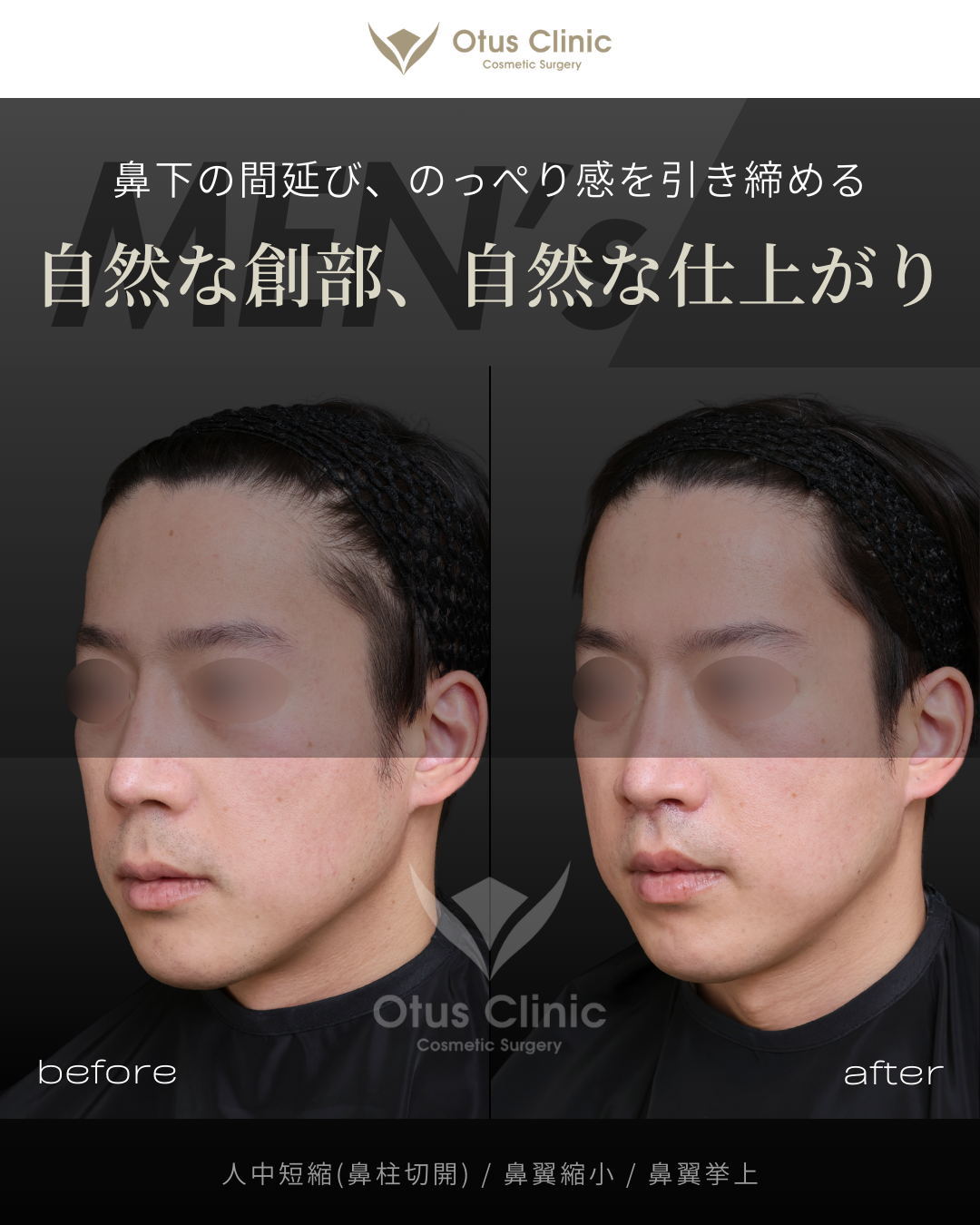 鼻柱切開人中短縮・鼻翼縮小・鼻翼挙上