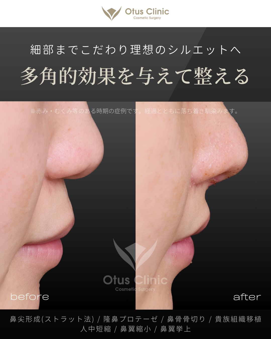 鼻尖形成(耳介軟骨移植つき)・ストラット法・隆鼻プロテーゼ・鼻骨骨切り・貴族組織移植・鼻柱切開人中短縮・鼻翼縮小・鼻翼挙上