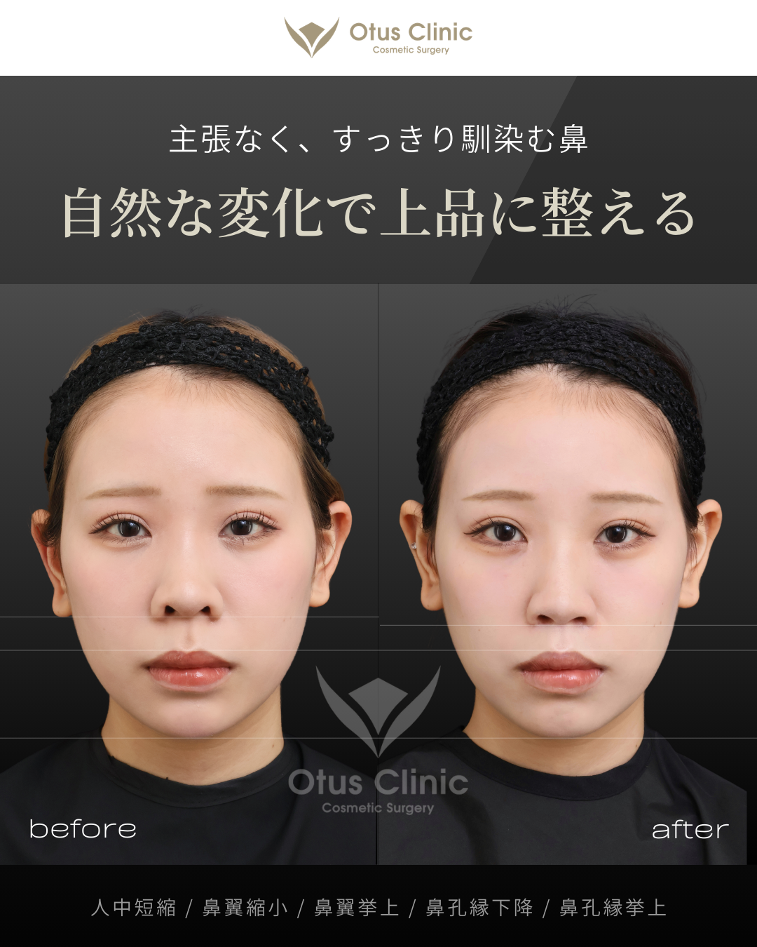 人中短縮・鼻翼縮小・鼻翼挙上・鼻孔縁下降・鼻孔縁挙上