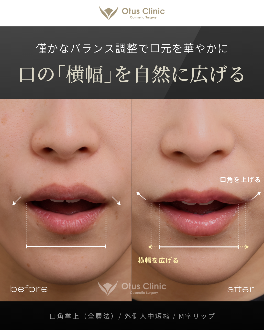 口角挙上（全層法）・外側人中短縮・M字リップ