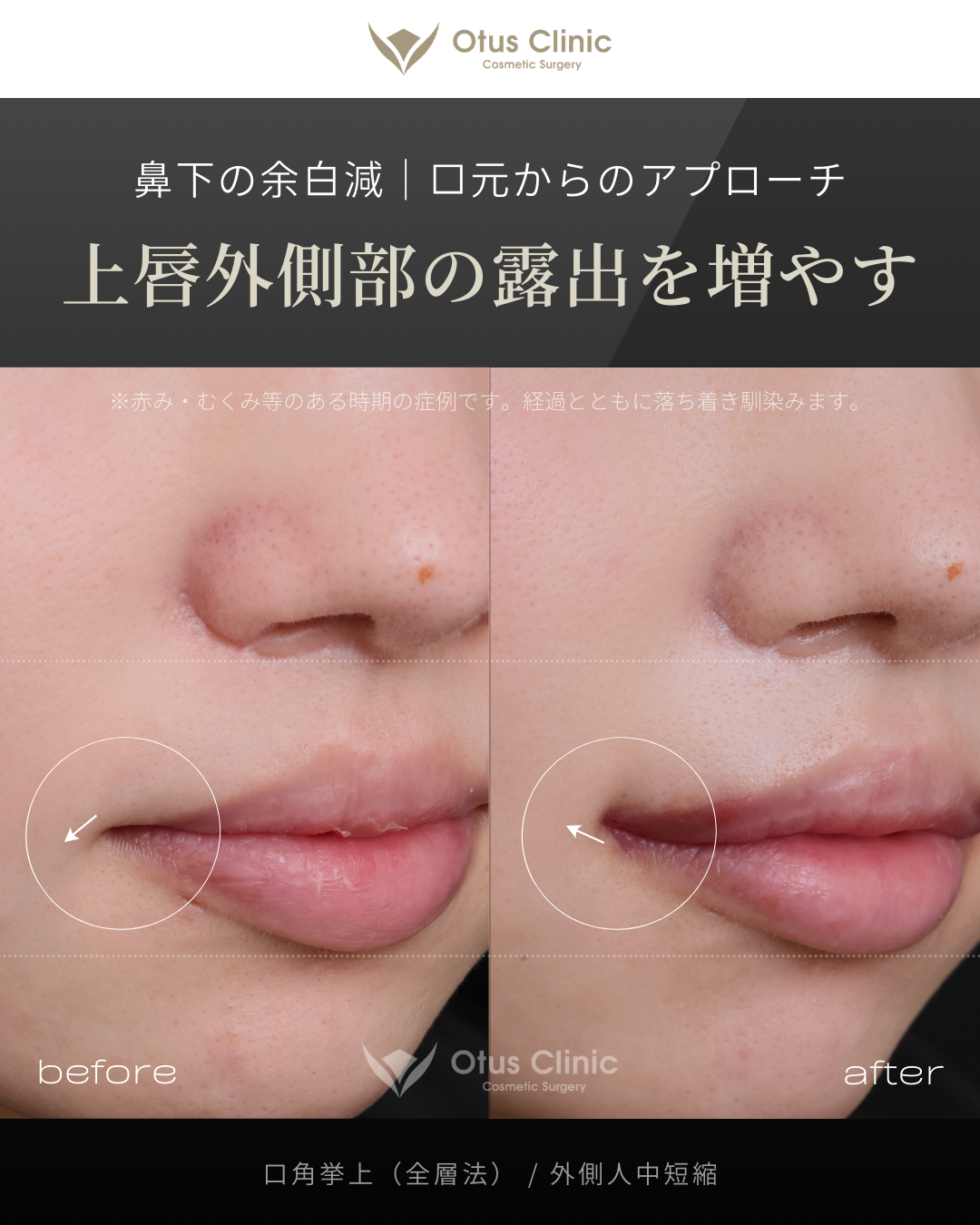 口角挙上（全層法）・外側人中短縮