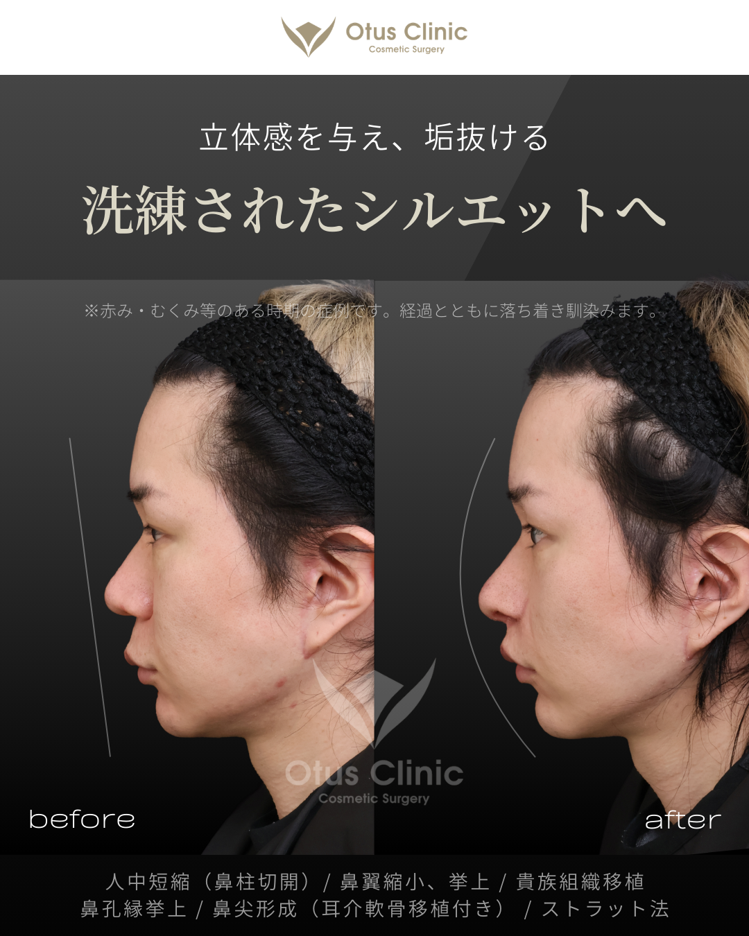 鼻柱切開人中短縮・鼻翼縮小・鼻翼挙上・貴族組織移植・鼻孔縁挙上 ・鼻尖形成（耳介軟骨移植付き）・ストラット法
