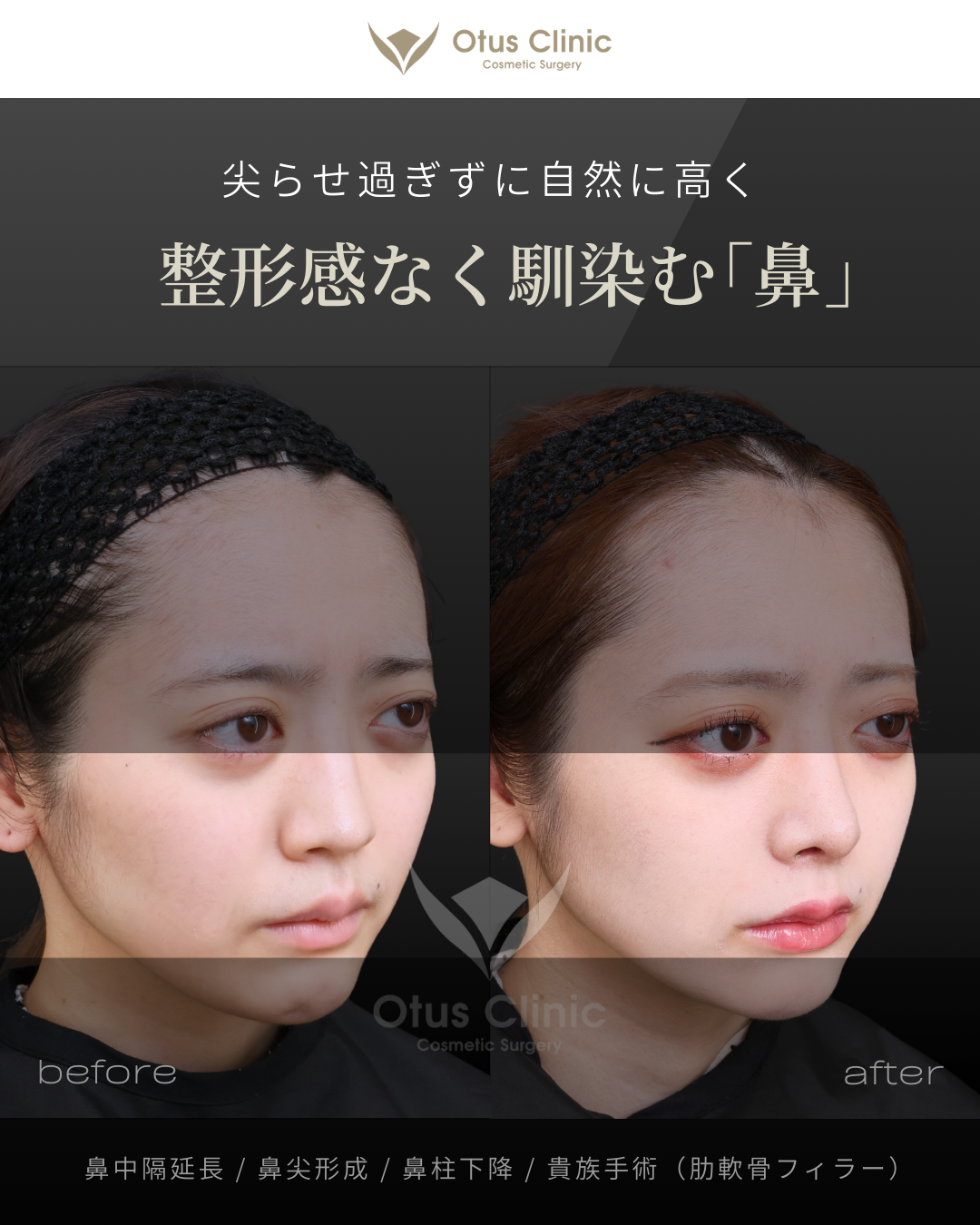 鼻中隔延長（肋軟骨）・鼻尖形成・鼻柱下降・貴族手術（肋軟骨フィラー）