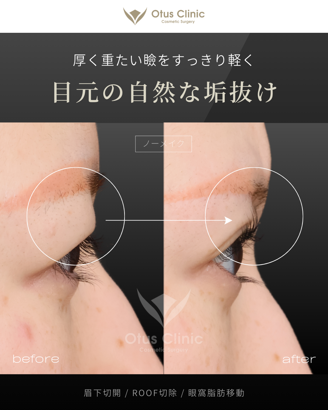 眉下切開・ROOF切除・眼窩脂肪移動