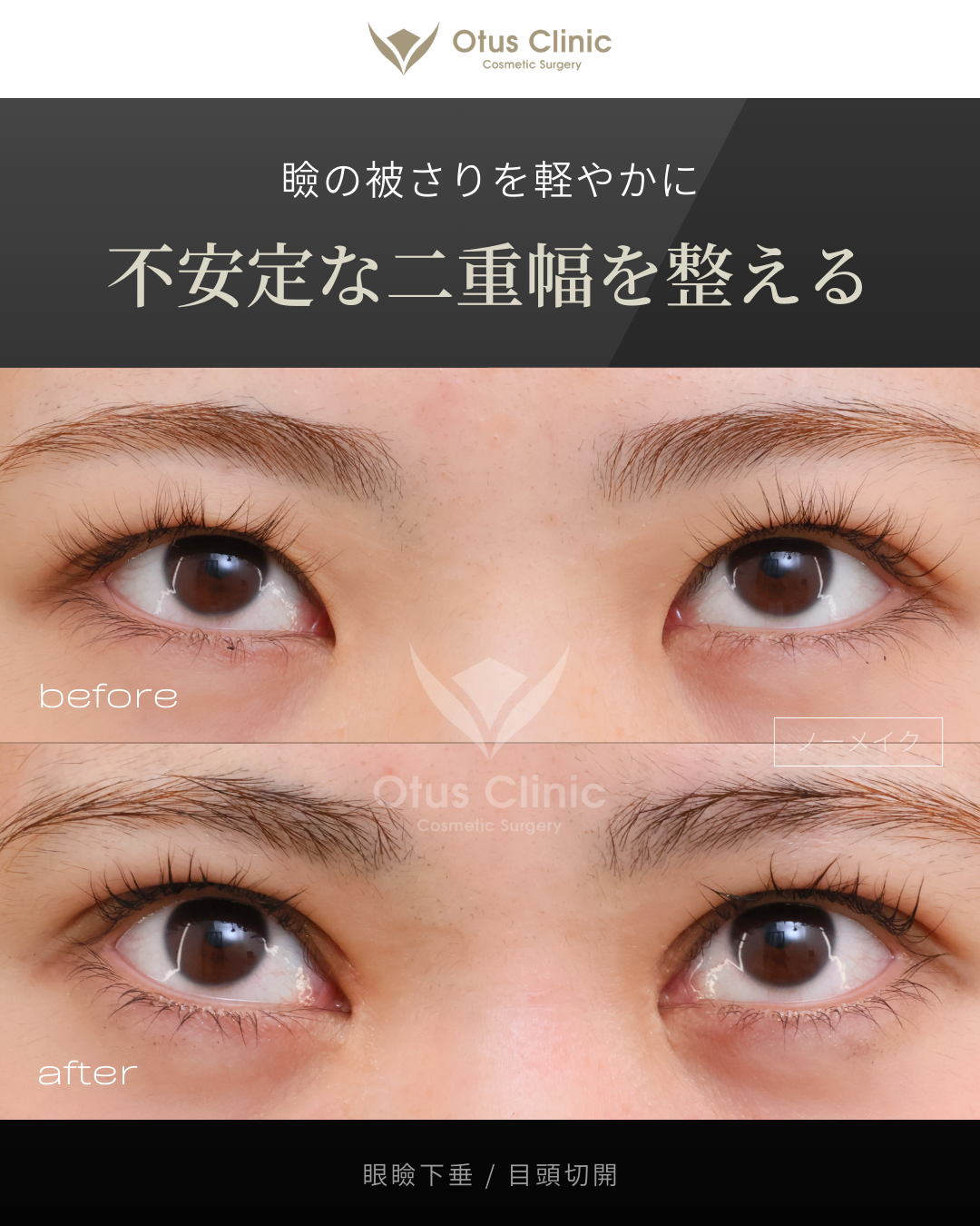 眼瞼下垂・目頭切開