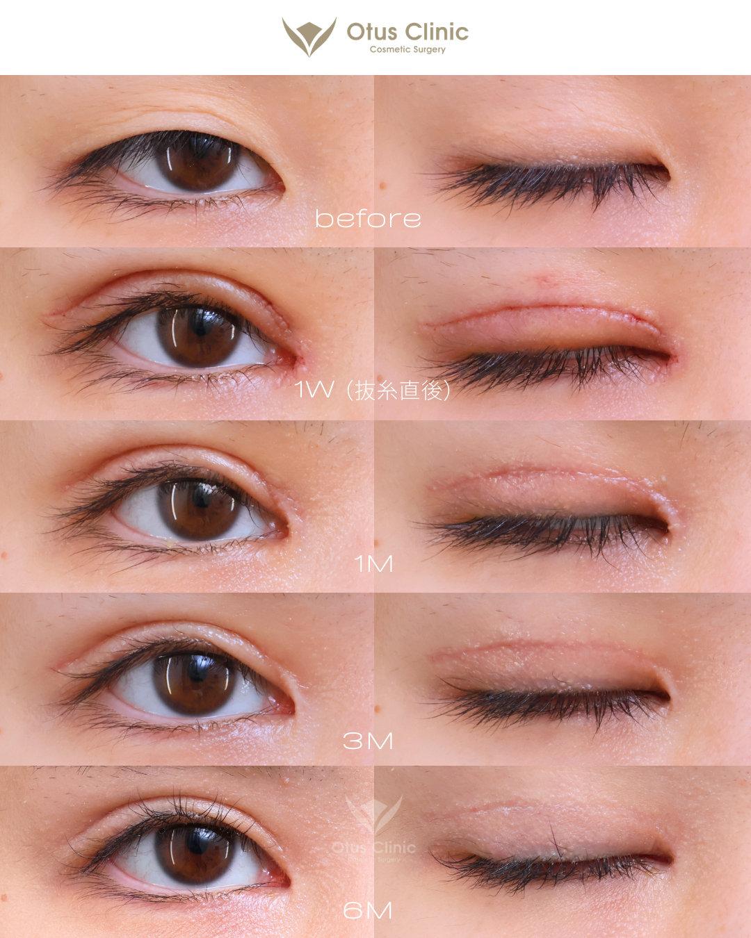 眼瞼下垂・目頭切開