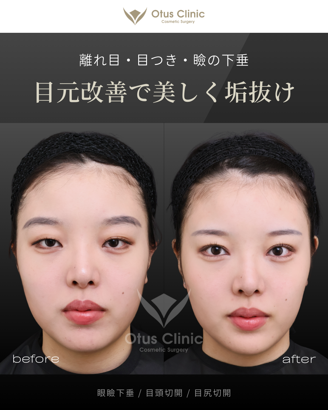 眼瞼下垂・目頭切開・目尻切開