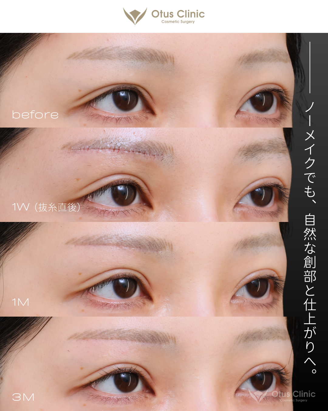 眉下切開（右のみ）