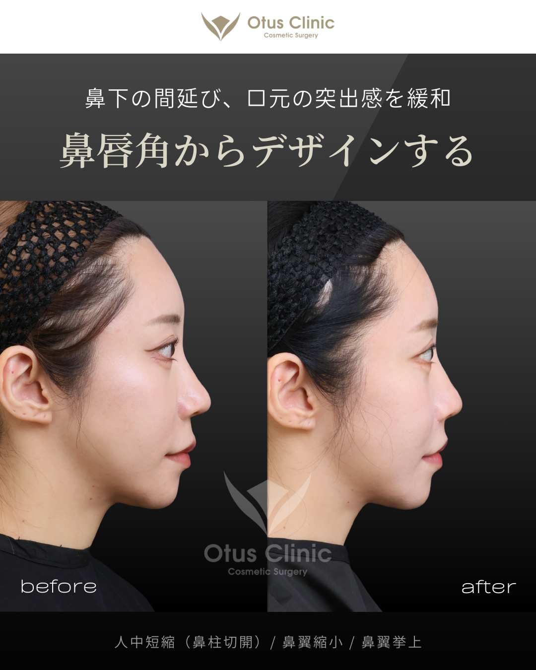 鼻柱切開人中短縮・鼻翼縮小・鼻翼挙上