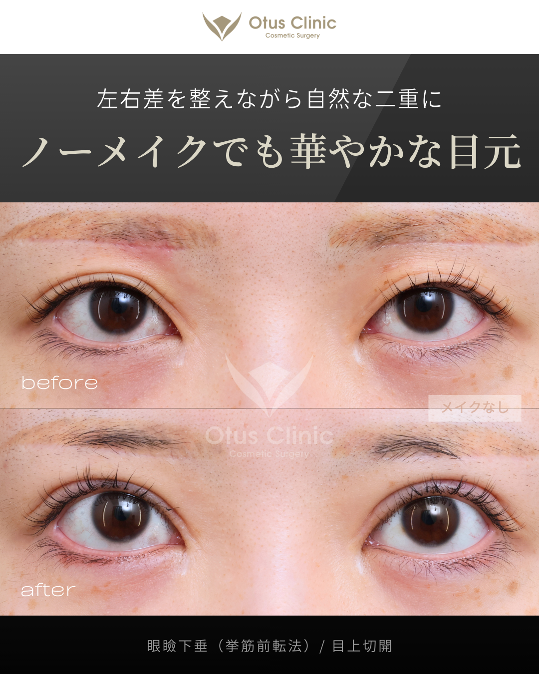 眼瞼下垂（挙筋前転法）・目上切開