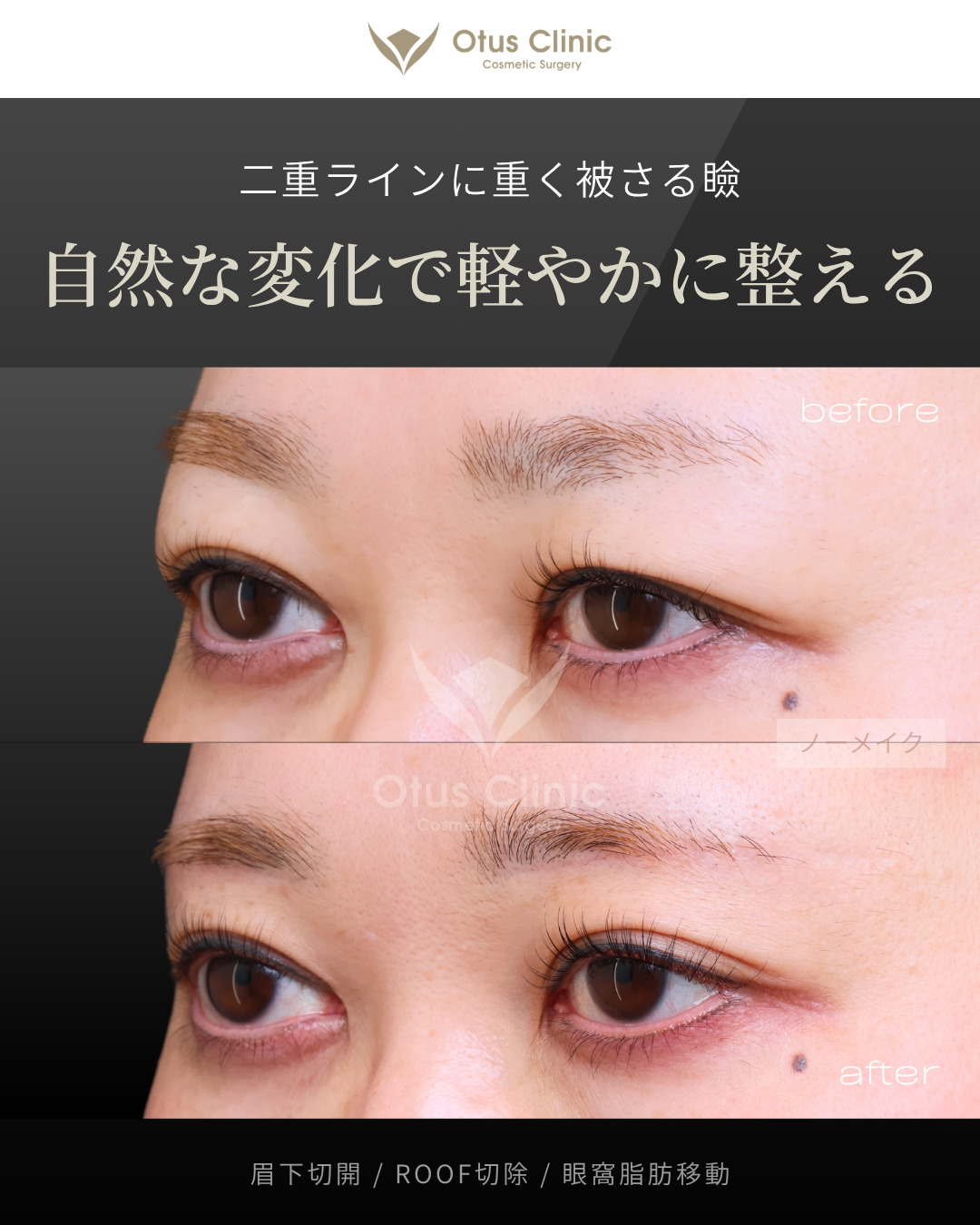 眉下切開・ROOF切除・眼窩脂肪移動