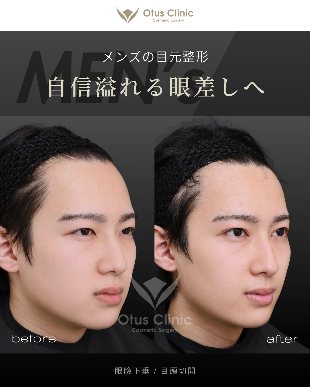 眼瞼下垂・目頭切開