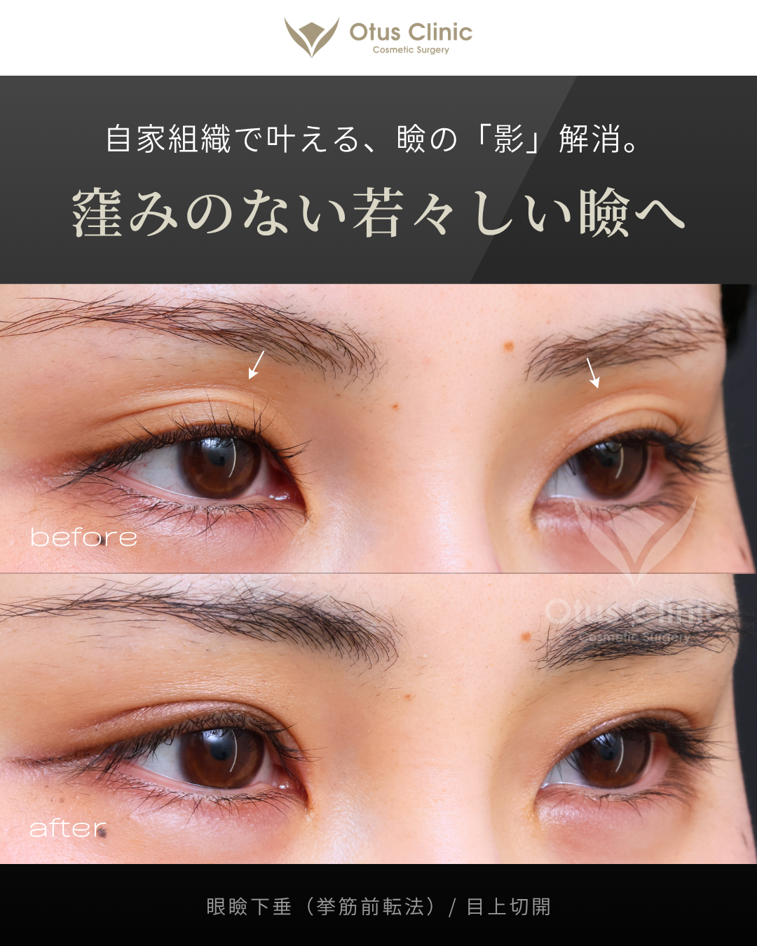 眼瞼下垂（挙筋前転法）・目上切開