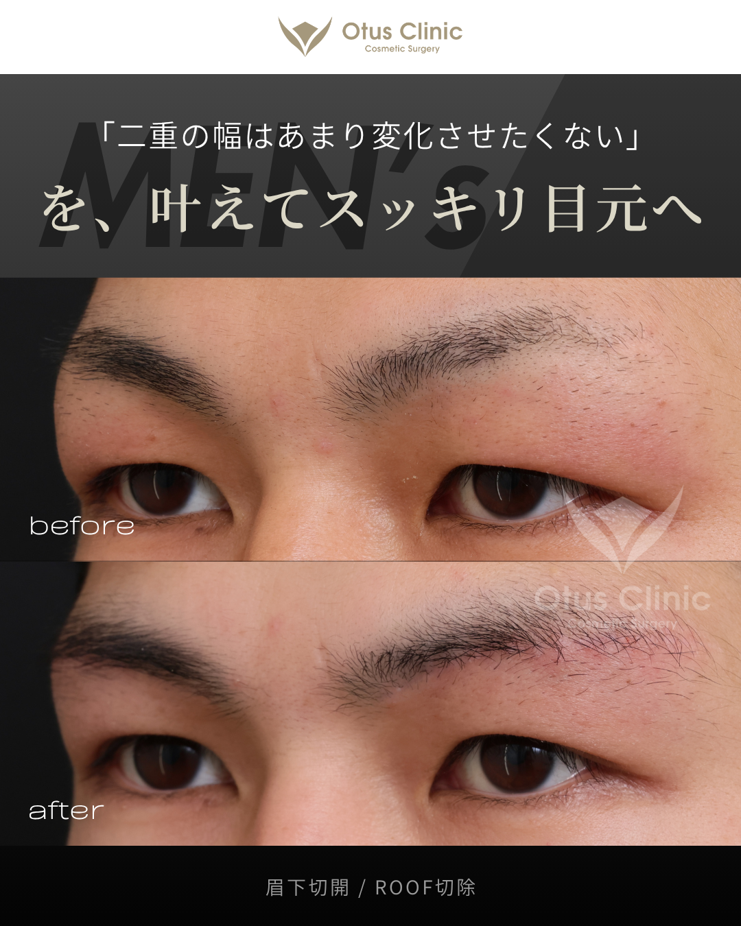眉下切開・ROOF切除