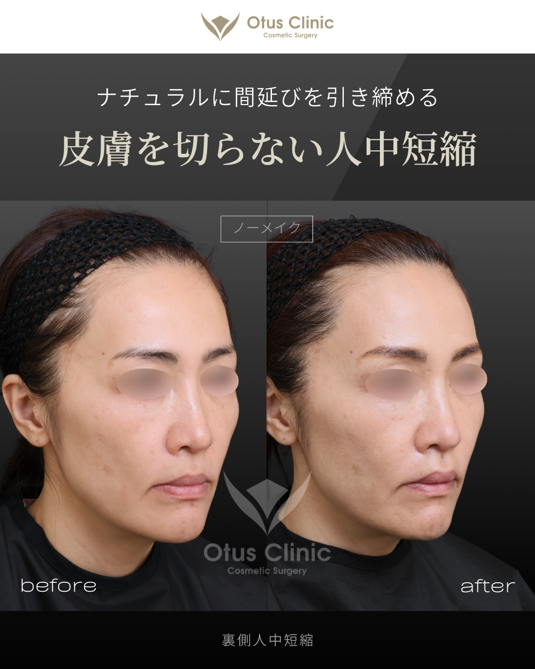 裏側人中短縮（切らない人中短縮）