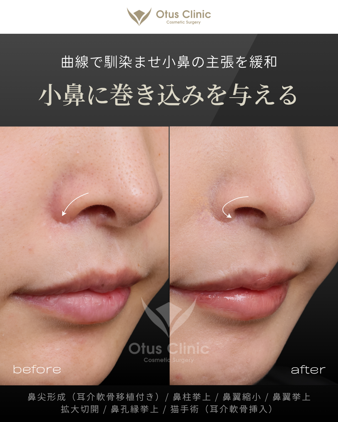 鼻尖形成（耳介軟骨移植付き）・鼻柱挙上・鼻翼縮小・鼻翼挙上・拡大切開・鼻孔縁挙上・猫手術（耳介軟骨挿入）