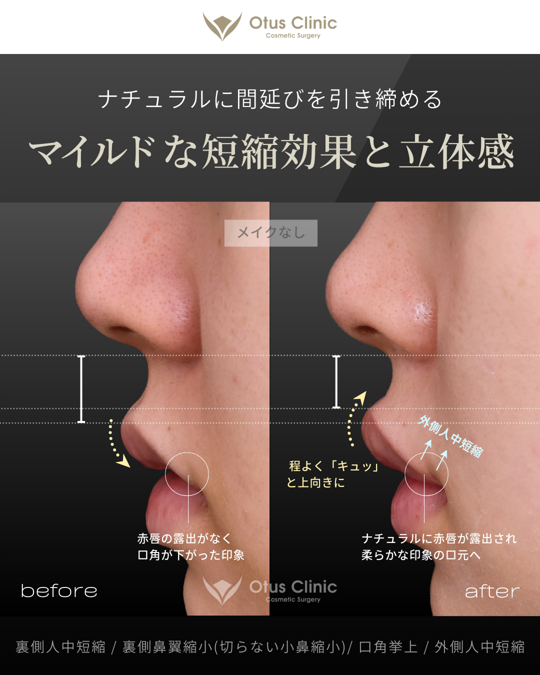 裏側人中短縮・裏側鼻翼縮小(切らない鼻翼縮小)・口角挙上・外側人中短縮