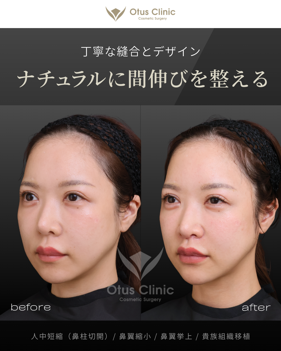 鼻柱切開人中短縮・貴族組織移植・鼻翼縮小・鼻翼挙上