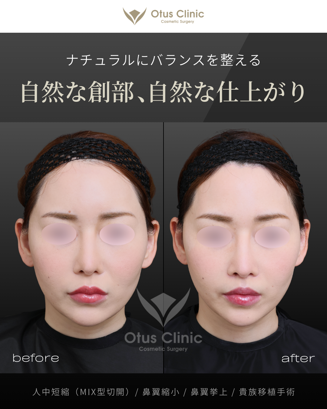 人中短縮(鼻柱切開×鼻腔内切開)・鼻翼縮小・鼻翼挙上・貴族組織移植