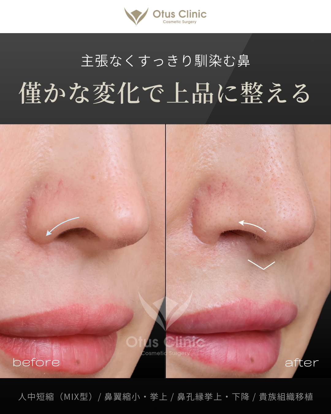 人中短縮（鼻柱切開×鼻腔内切開）・鼻翼縮小・鼻翼挙上・鼻孔縁挙上・鼻孔縁下降・貴族組織移植