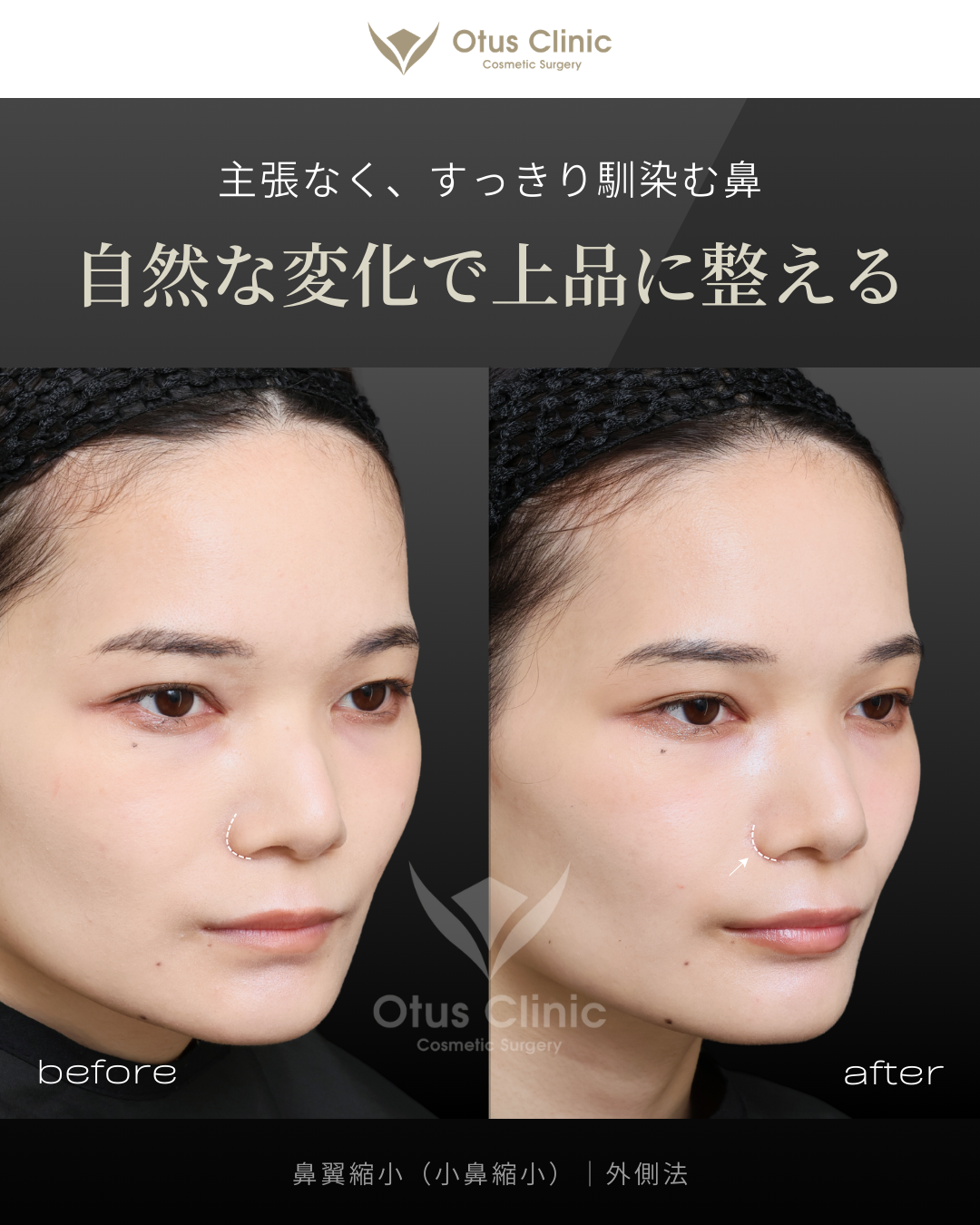 鼻翼縮小（小鼻縮小）｜外側法