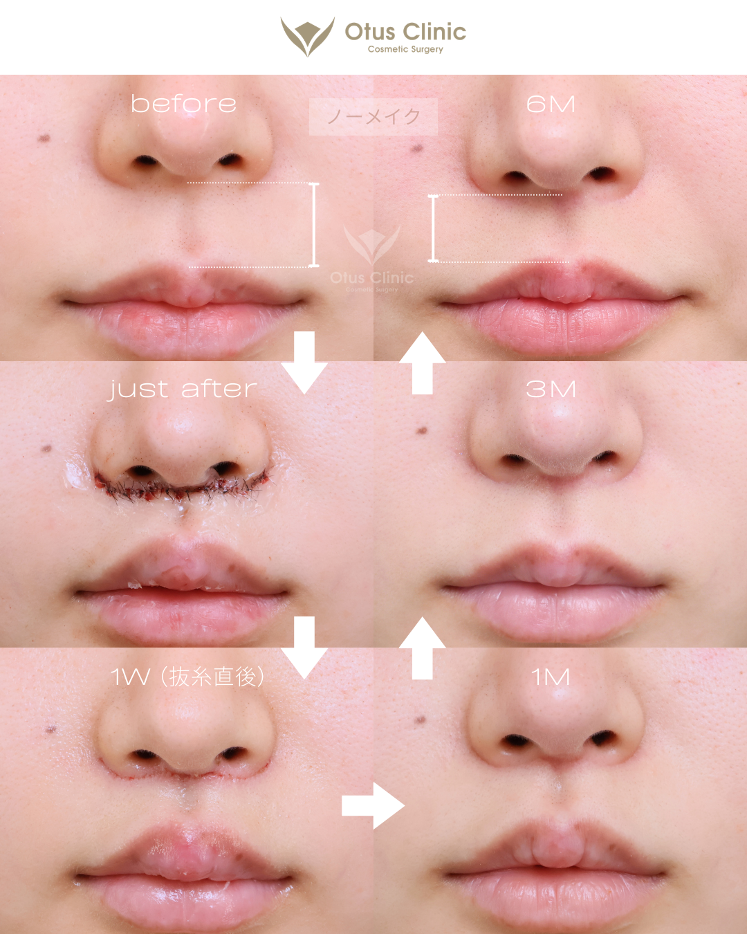 人中短縮（鼻下切開）