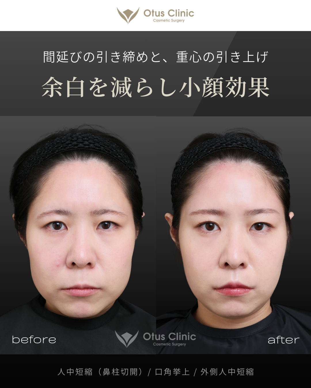 鼻柱切開人中短縮・口角挙上・外側人中短縮