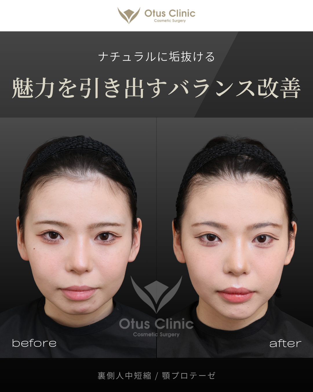 裏側人中短縮（切らない人中短縮）・顎プロテーゼ